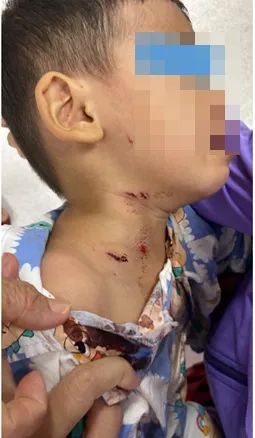 Bé trai nhập viện với nhiều vết thương do chó nhà cắn Bé trai nhập viện với nhiều vết thương do chó nhà cắn