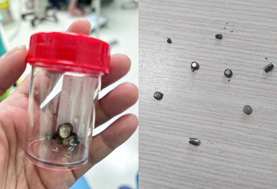 Các dị vật là pin và nam châm được lấy ra từ ruột bé trai 4 tuổi