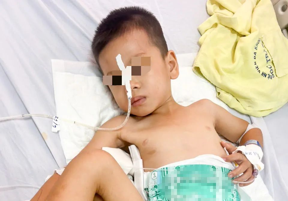 Sức khỏe bé trai 4 tuổi sau phẫu thuật diễn tiến tốt