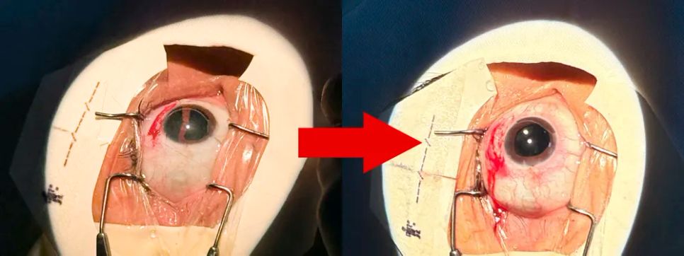Mắt bệnh nhân trước phẫu thuật (bìa trái) và sau phẫu thuật (bìa phải) Mắt bệnh nhân trước phẫu thuật (bìa trái) và sau phẫu thuật (bìa phải)