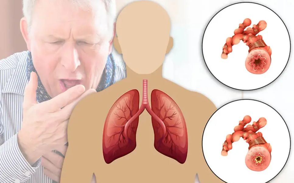 Bệnh phổi tắc nghẽn mạn tính: Âm thầm nhưng nguy hiểm