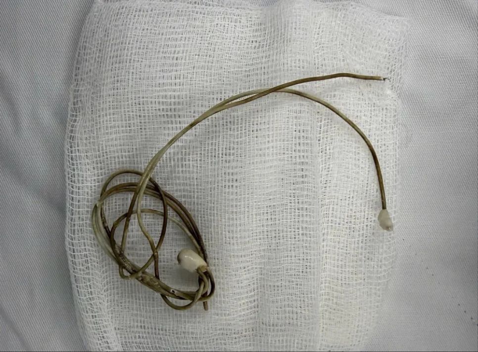 Sợi dây điện thoại mắc kẹt trong bàng quang bệnh nhân Sợi dây điện thoại mắc kẹt trong bàng quang bệnh nhân