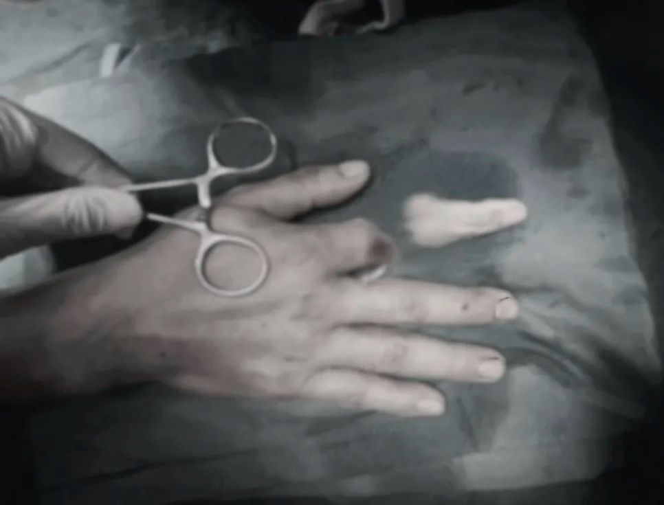 Ảnh chụp bàn tay và ngón tay bị đứt rời của bệnh nhân D. Ảnh: BVCC Ảnh chụp bàn tay và ngón tay bị đứt rời của bệnh nhân D. Ảnh: BVCC