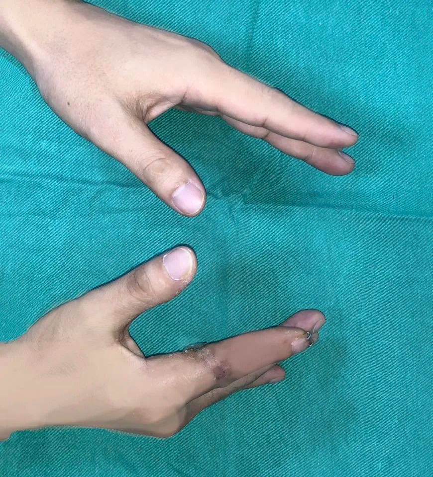 Ngón tay của bệnh nhân D. được nối lại đã có thể cử động Ngón tay của bệnh nhân D. được nối lại đã có thể cử động