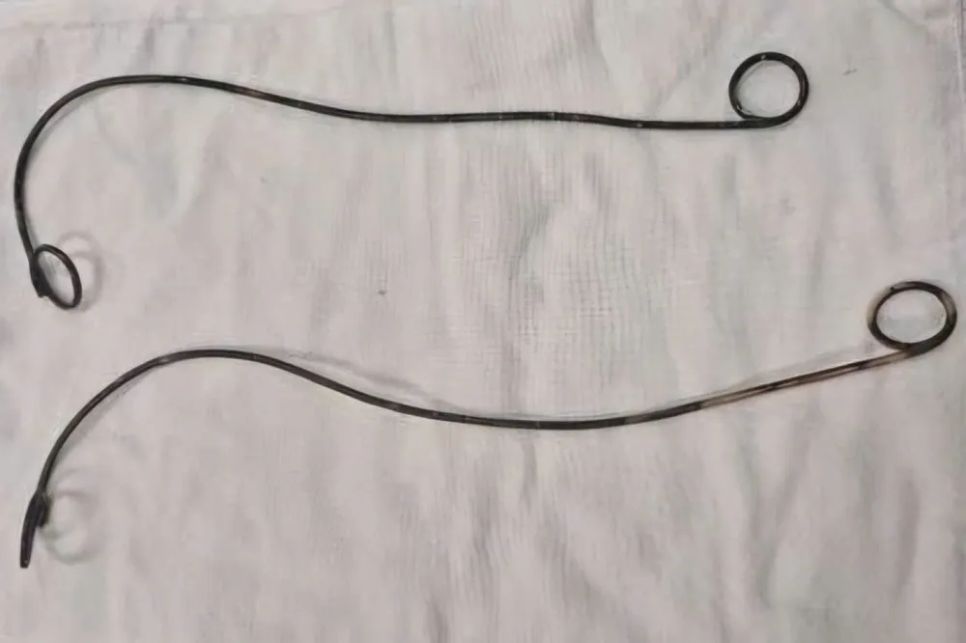 2 ống thông JJ bị bỏ quên trong cơ thể bệnh nhân L.V.E.