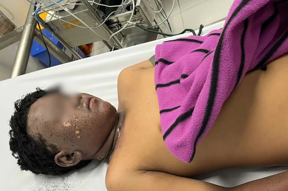 Bệnh nhi 13 tuổi bỏng đen vùng mặt vì tai nạn pháo nổ.