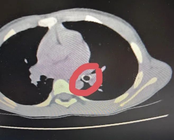 Cảnh báo hóc dị vật đường hô hấp từ thói quen ngậm đầu ngòi bút