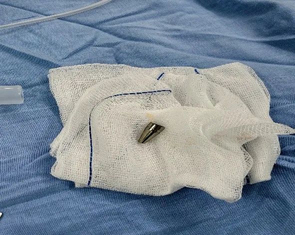 Dị vật là đầu ngòi bút nhựa