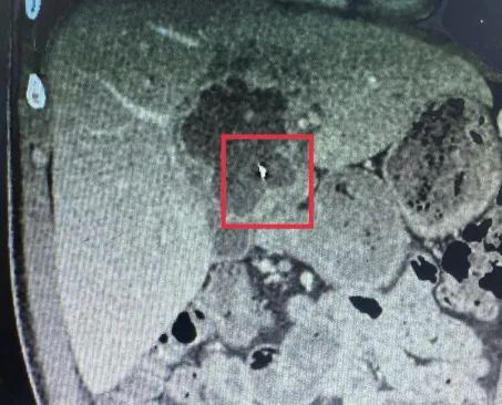 Hình ảnh dị vật trong gan bệnh nhân