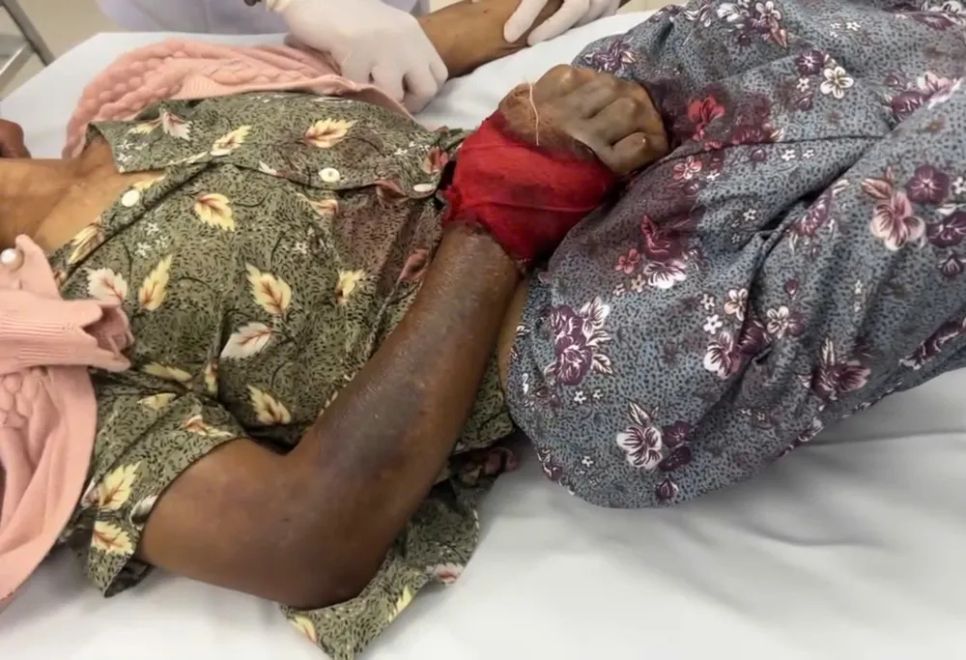 Tay nạn nhân bị rắn độc cắn sưng to, tím đen và có dấu hiệu hoại tử