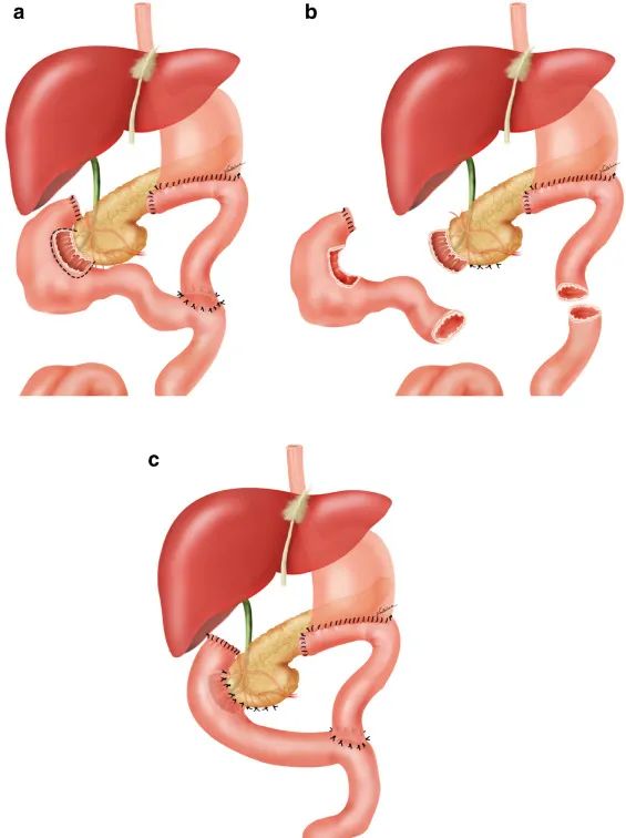 Minh họa kỹ thuật tái tạo đường tiêu hóa sau khi cắt bỏ tá tràng. Ảnh: ScienceDirect