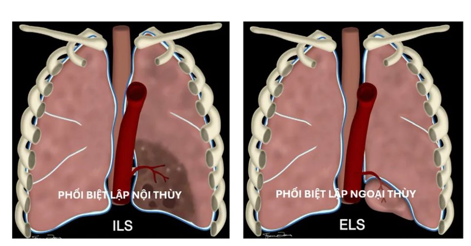 Minh hoạ phổi biệt lập nội thùy và ngoại thùy
