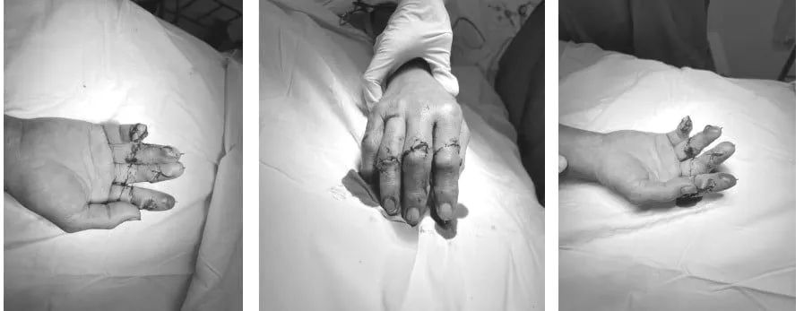 Các ngón tay của bệnh nhân được nối liền sau ca vi phẫu kéo dài 8 giờ