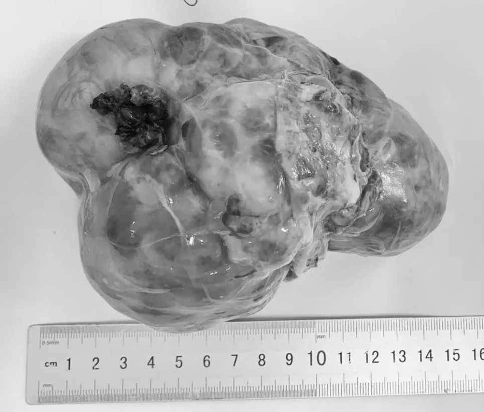 Khối u ổ bụng được phát hiện trong quá trình phẫu thuật cho bệnh nhi