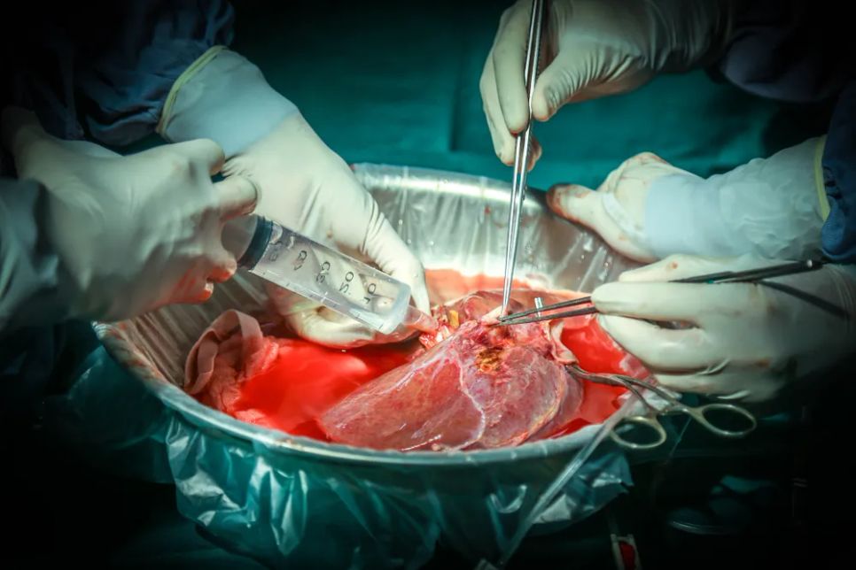 Lá gan của người hiến được lấy ra để ghép cho một bệnh nhân mắc bệnh hiểm nghèo. Ảnh: BVCC