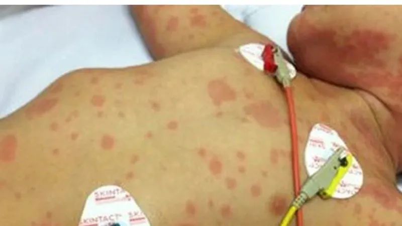 Trẻ em mắc viêm não mô cầu rất nguy hiểm về nguy cơ biến chứng