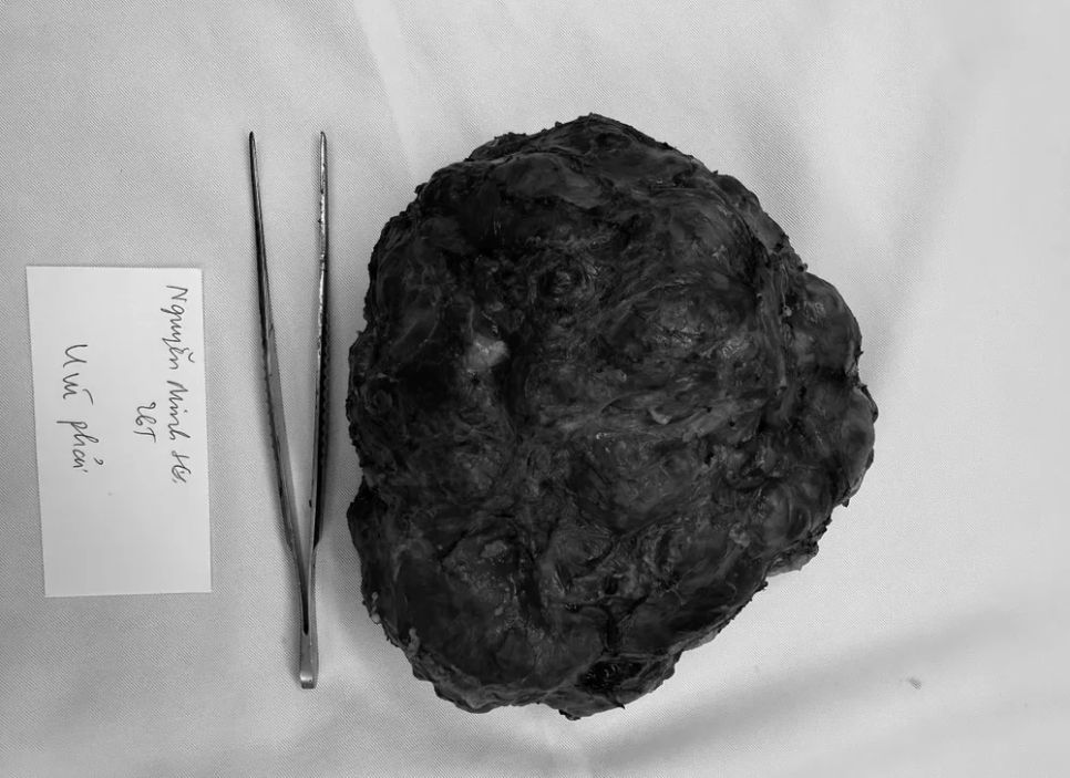 Khối u phyllode được lấy ra khỏi cơ thể người bệnh. Ảnh: BVCC