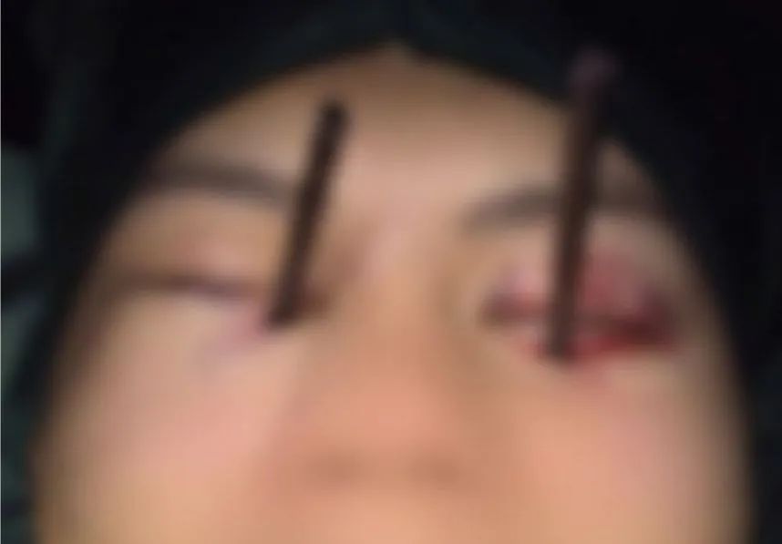 Bệnh nhân B.T.D. nhập viện trong tình trạng bị 2 chiếc đũa cắm sâu vào 2 bên mắt. Ảnh: BVCC