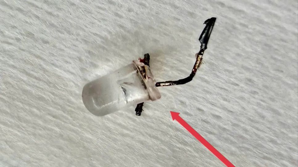 Dị vật được gắp ra từ phế quản bệnh nhi.