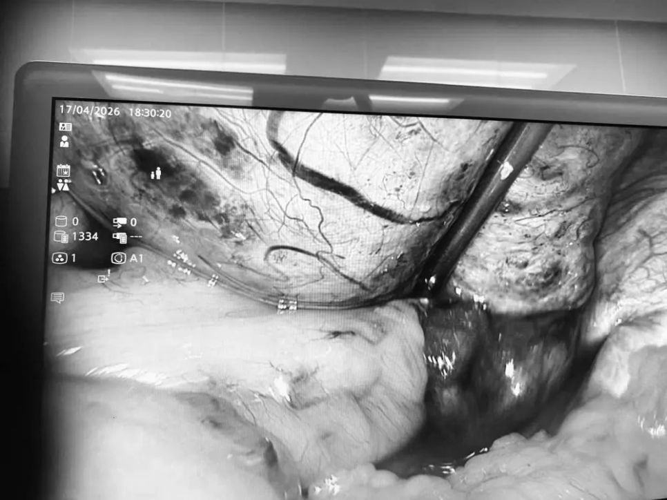 Quá trình nội soi cắt bỏ khối u