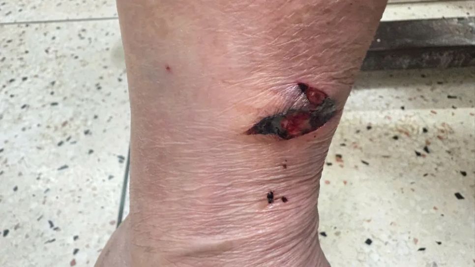 Vết thương mèo cắn trên chân trái của bệnh nhân.