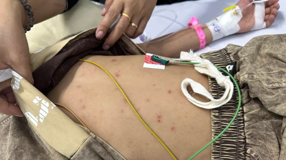 Các ban xuất huyết trên cơ thể bệnh nhi.
