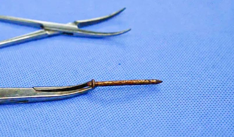 Cây đinh 4cm được các bác sĩ lấy ra trong bụng bệnh nhân