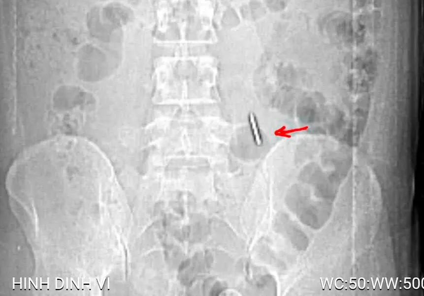 Vị trí cây đinh xuyên qua thành bụng