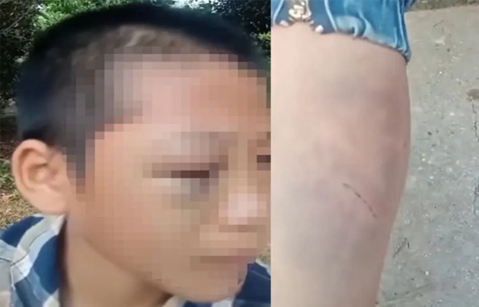 Bé trai bị nhiều vết bầm tím trên cơ thể. Ảnh cắt từ video