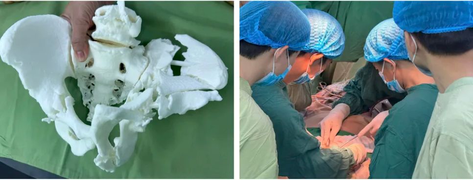 Ứng dụng công nghệ in 3D để tái tạo chính xác cấu trúc khung chậu của người bệnh trước mổ