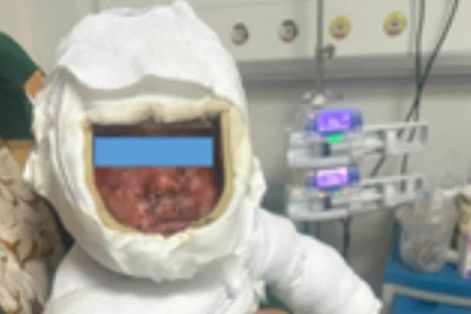 Cấp cứu thành công bé trai 9 tháng tuổi bỏng nặng do nước sôi