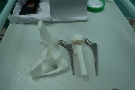 Ứng dụng công nghệ in 3D phẫu thuật thành công ca loạn sản khớp háng hiếm gặp