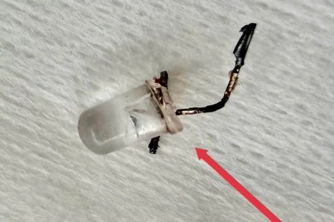 Bác sĩ căng thẳng gắp bóng đèn trong đường thở bé gái 