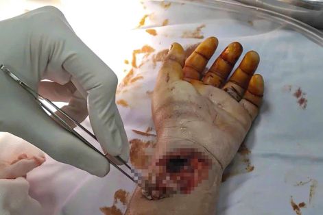 Bé trai 9 tuổi bị kính cắt động mạch tay trong lúc vui đùa