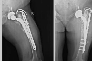 Lần đầu ở miền Trung - Tây Nguyên thay khớp háng và xương đùi bằng Megaprosthesis 