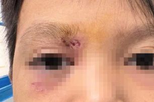 Mảnh gỗ 1,5cm khiến bé trai suýt mù loà