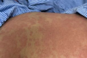 Nguy kịch sau khi dùng thuốc giảm cân thải độc không rõ nguồn gốc