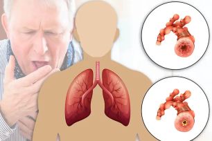 Bệnh phổi tắc nghẽn mạn tính: Âm thầm nhưng nguy hiểm