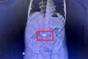 Khánh Hòa: Trong một tháng, bệnh viện tiếp nhận 5 trẻ nuốt đồng xu 