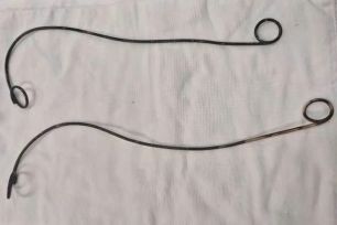 Phẫu thuật lấy 2 ống thông JJ bị bỏ quên trong cơ thể bệnh nhân hơn 10 năm