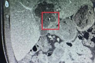 Vĩnh Long: Phẫu thuật lấy kim may đồ 6cm trong gan của bệnh nhân