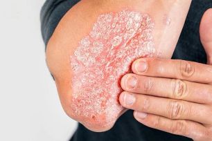 Hơn 288.500 người trưởng thành đang sống chung với bệnh vảy nến