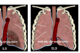 Lần đầu tiên phẫu thuật robot cắt phổi biệt lập