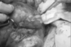 Cà Mau: Phẫu thuật thành công khối u đa nhân xơ tử cung nặng 2,1kg