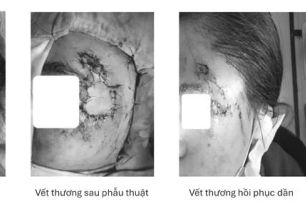 Ghép da thành công cho người bệnh bị hoại tử vùng mặt sau tai nạn giao thông