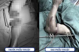 Hồi sinh cánh tay đứt lìa, dập nát do tai nạn lao động