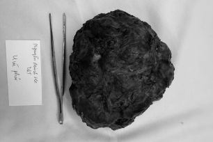 Đang du học tại Đức, nữ sinh về Việt Nam điều trị khối u vú khổng lồ