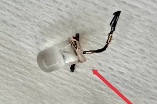 Bác sĩ căng thẳng gắp bóng đèn trong đường thở bé gái 