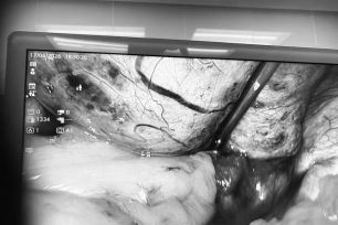 Đau âm ỉ bị bỏ qua, cô gái 24 tuổi suýt mất buồng trứng vì khối u xoắn 5 vòng